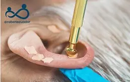 Auriculoterapia en Quito